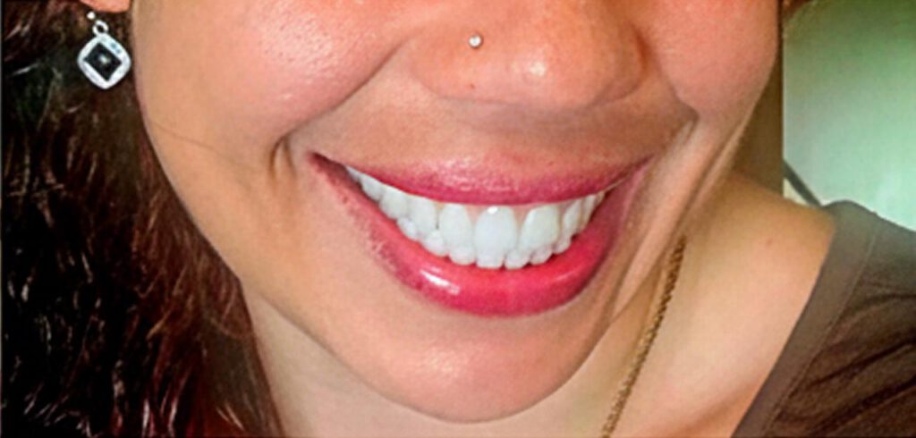 Patient smile after receiving custom dentures at First Choice Denture Clinic